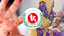 ২৪ ঘন্টায় হাম উপসর্গে তিনজনের মৃত্যু ২৪ ঘন্টায় হাম উপসর্গে তিনজনের মৃত্যু