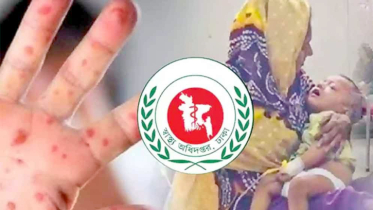 দেশে হাম উপসর্গে আরও ৫ শিশুর মৃত্যু