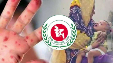 হাম উপসর্গে আরও ৭ শিশুর মৃত্যু
