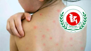 হাম ও উপসর্গে আরো ৬ শিশুর মৃত্যু