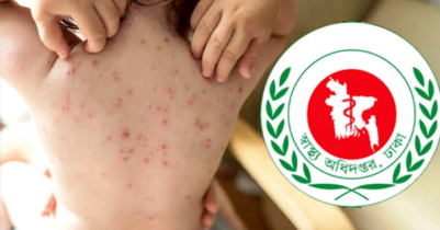 হাম উপসর্গে প্রাণ গেল আরও ৬ শিশুর