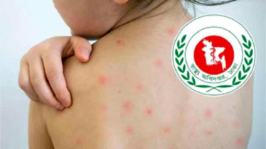 হাম ও হামের উপসর্গে আরও ১২ শিশুর মৃত্যু