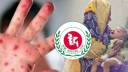 হামের উপসর্গে আরও ৭ শিশুর মৃত্যু হামের উপসর্গে আরও ৭ শিশুর মৃত্যু